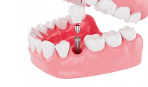How Much Do Dental Implants Cost? A Quick Guide